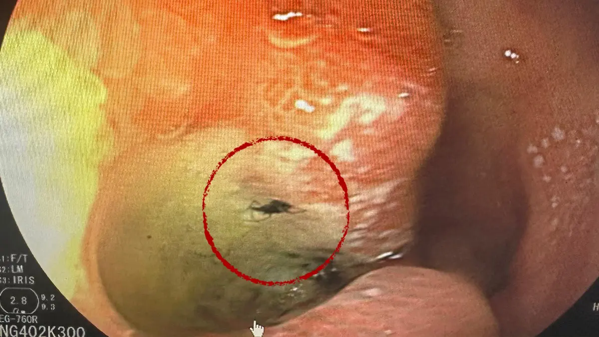 İnanması zor olayın adresi Aydın! Böcek adamı midesinden ısırdı