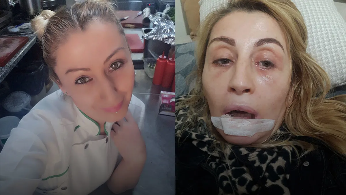 Antalya'da estetik faciası: İşlem sonrası dudağı çürüdü! 'Gülüşüm yok'