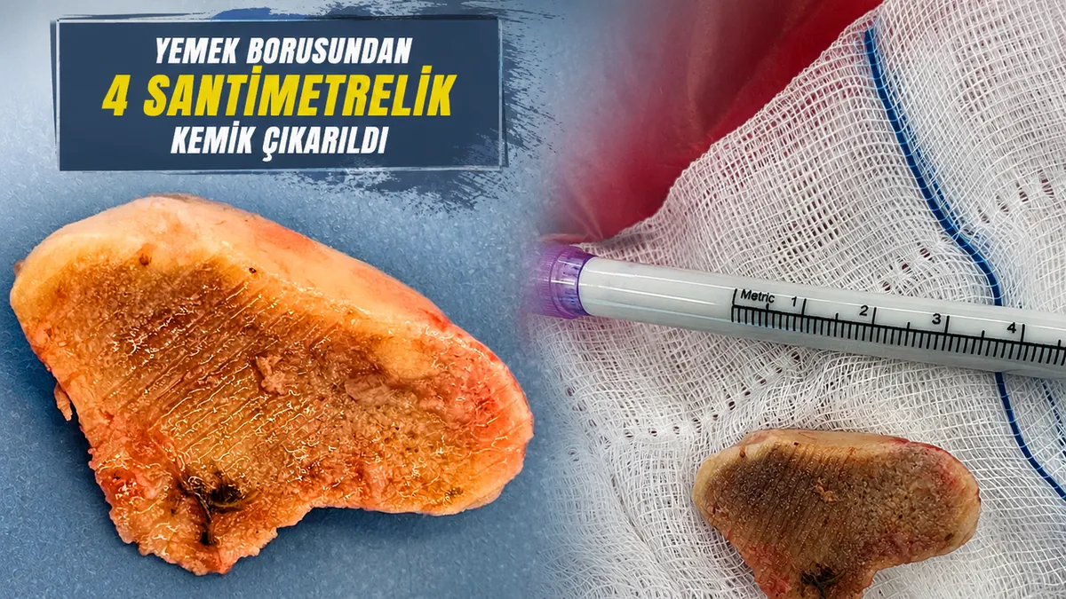 Takma dişsiz et yedi, yemek borusundan kemik çıktı