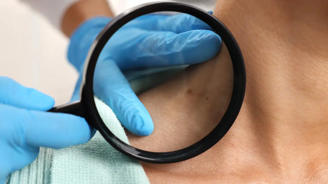 Sıradan bir leke sanarak geçiştirmeyin: Cilt kanserinin gözden kaçan gizli belirtileri açıklandı