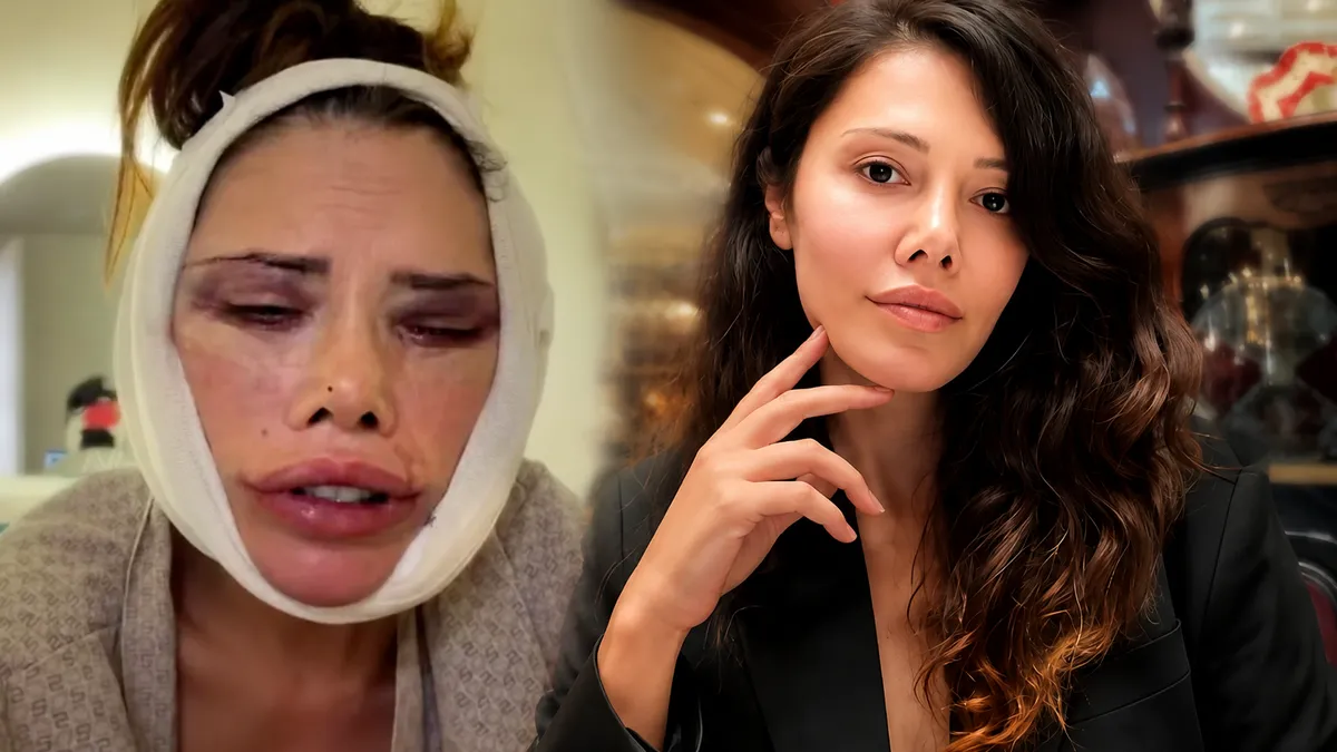Didem Ceran yeniden yüz ameliyatı oldu: 'Kurbana ihtiyaçları var'