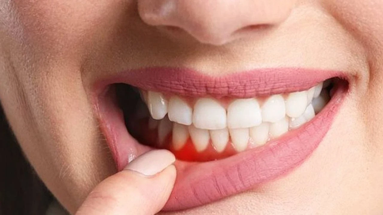 Stres ve vitamin eksikliği ağız içi yaraları tetikliyor