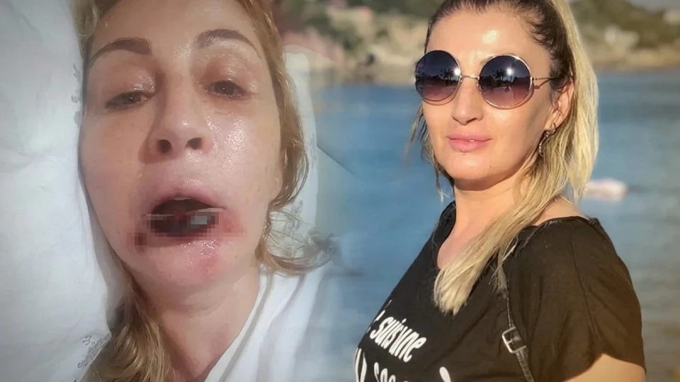 Antalya'da Estetik Faciası: Göz Altı Dolgusu İçin Gitti Dudak Dokusunu Kaybetti!