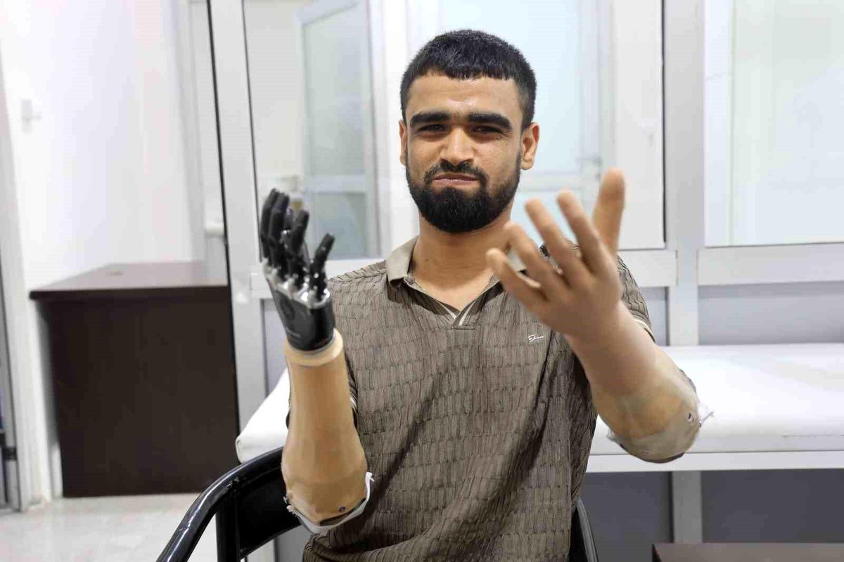 Demirin elektrik tellerine değmesiyle hayatı kararan Muhammed, 3 milyon TL değerindeki protez bacağına ve 2 biyonik kolu..