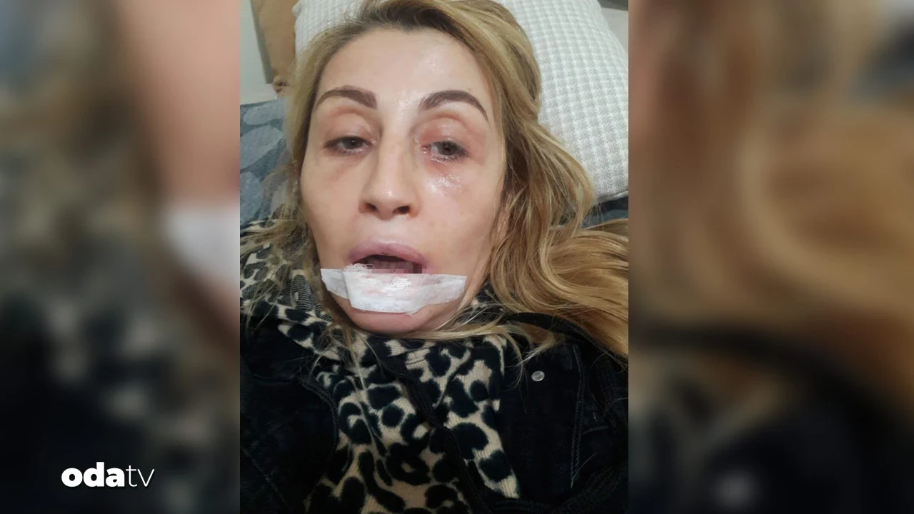 Estetik sonrası dudağı çürüdü