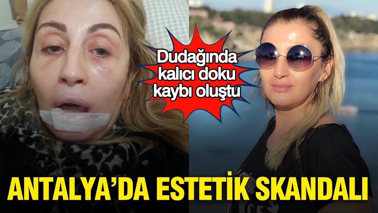 Antalya’da estetik skandalı: Dudağında kalıcı doku kaybı oluştu