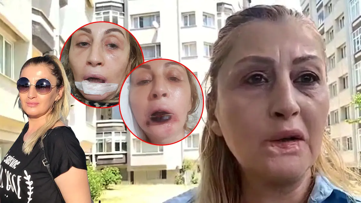 Güzellik uğruna hayatı hayatı karardı! Estetik kabusu dudaklarından etti
