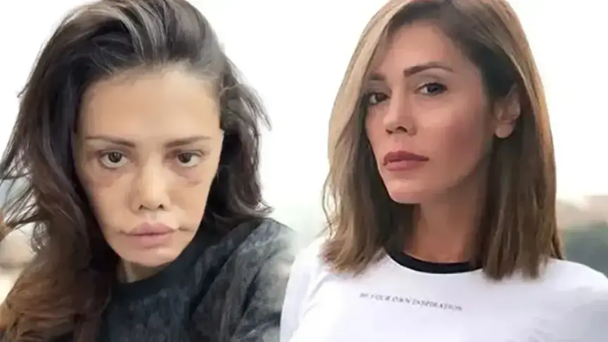 Yeni Görüntüleri Gündem Olmuştu! Yüz Nakli Olan Didem Ceran İsyan Etti: Beni CİMER’e Şikayet Etmişler