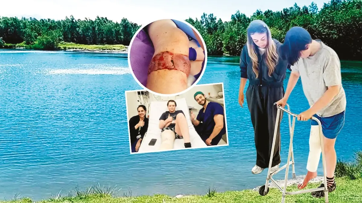Et yiyen bakteri kâbusu! Göle atladı bacağını kaybedecekti