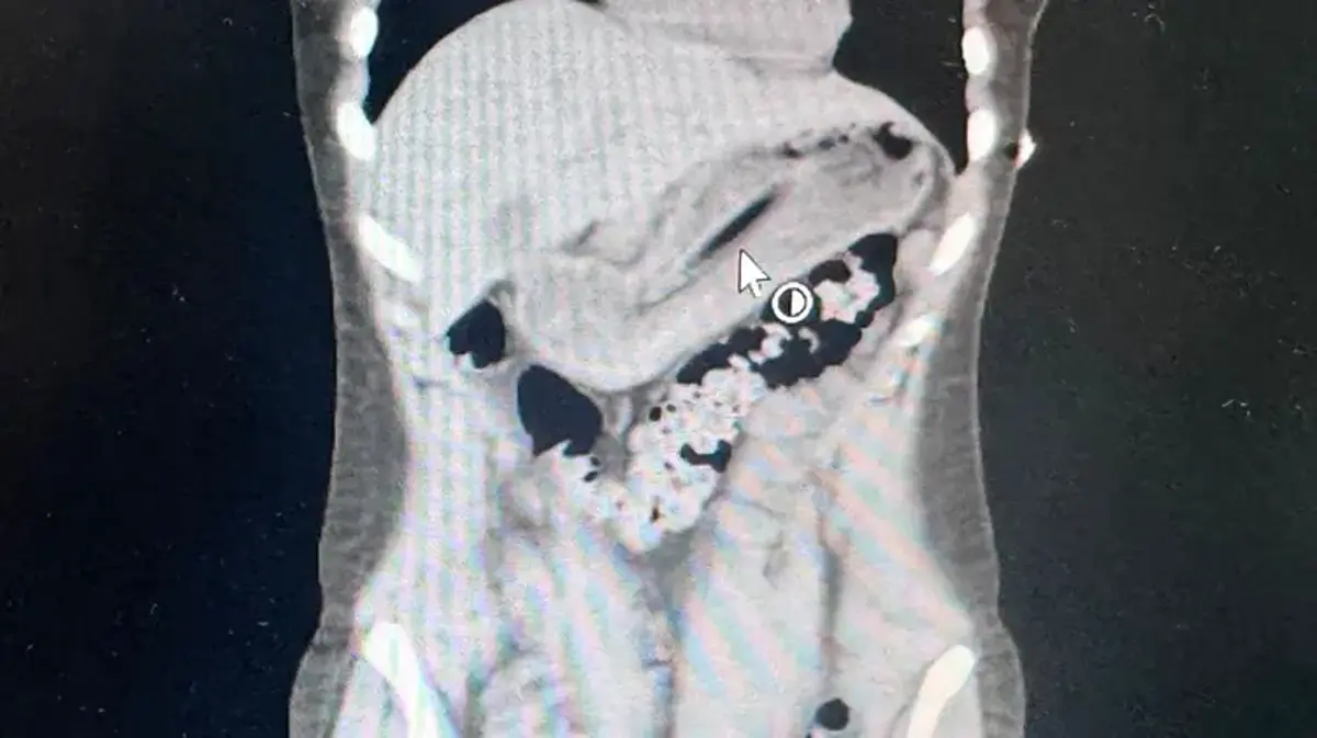 Zayıflamak isteyen genç kızın midesinden diş fırçası çıktı! Doktorlar röntgeni açınca şoke oldular