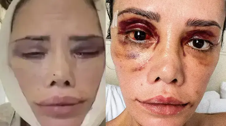 Yüz nakli olan Survivor Didem Ceran son halini paylaştı! 'Hepinizden çok özür diliyorum'