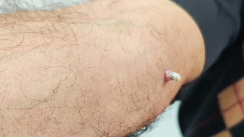 Kolundaki yara için gitti, kanser olduğunu öğrendi