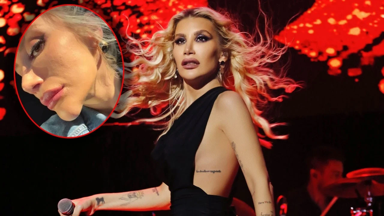 İrem Derici'nin çenesindeki şişlik olay oldu! Dolgu sanıldı, gerçek ortaya çıktı