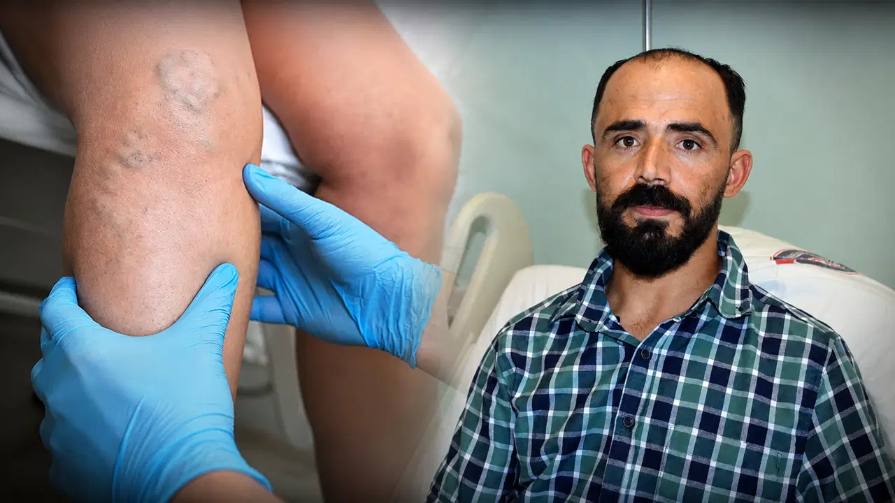 Dünyada sadece birkaç tane vaka var: Sedef hastalığı nedeniyle atardamarı yırtıldı!