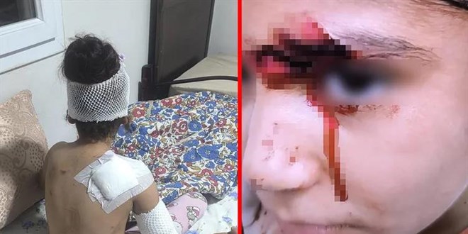 Başıboş köpeklerin saldırdığı 8 yaşındaki çocuğa 150 dikiş atıldı