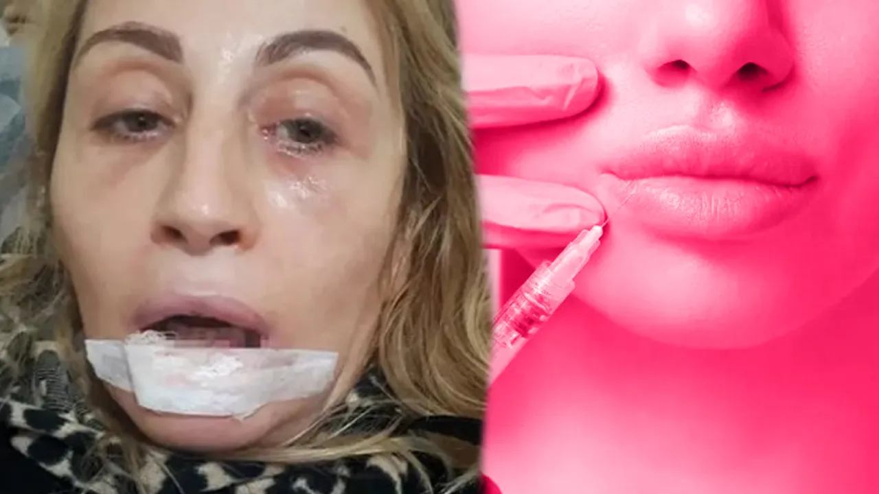 Dudak dolgusu faciası! Uzmanlardan hayat kurtaran "ilk 6 saat" uyarısı