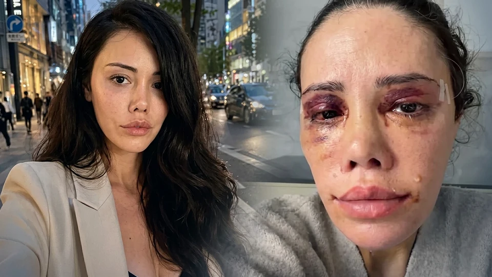 Didem Ceran neden yüz nakli yaptırdı? Survivor eski yarışmacısından CİMER açıklaması