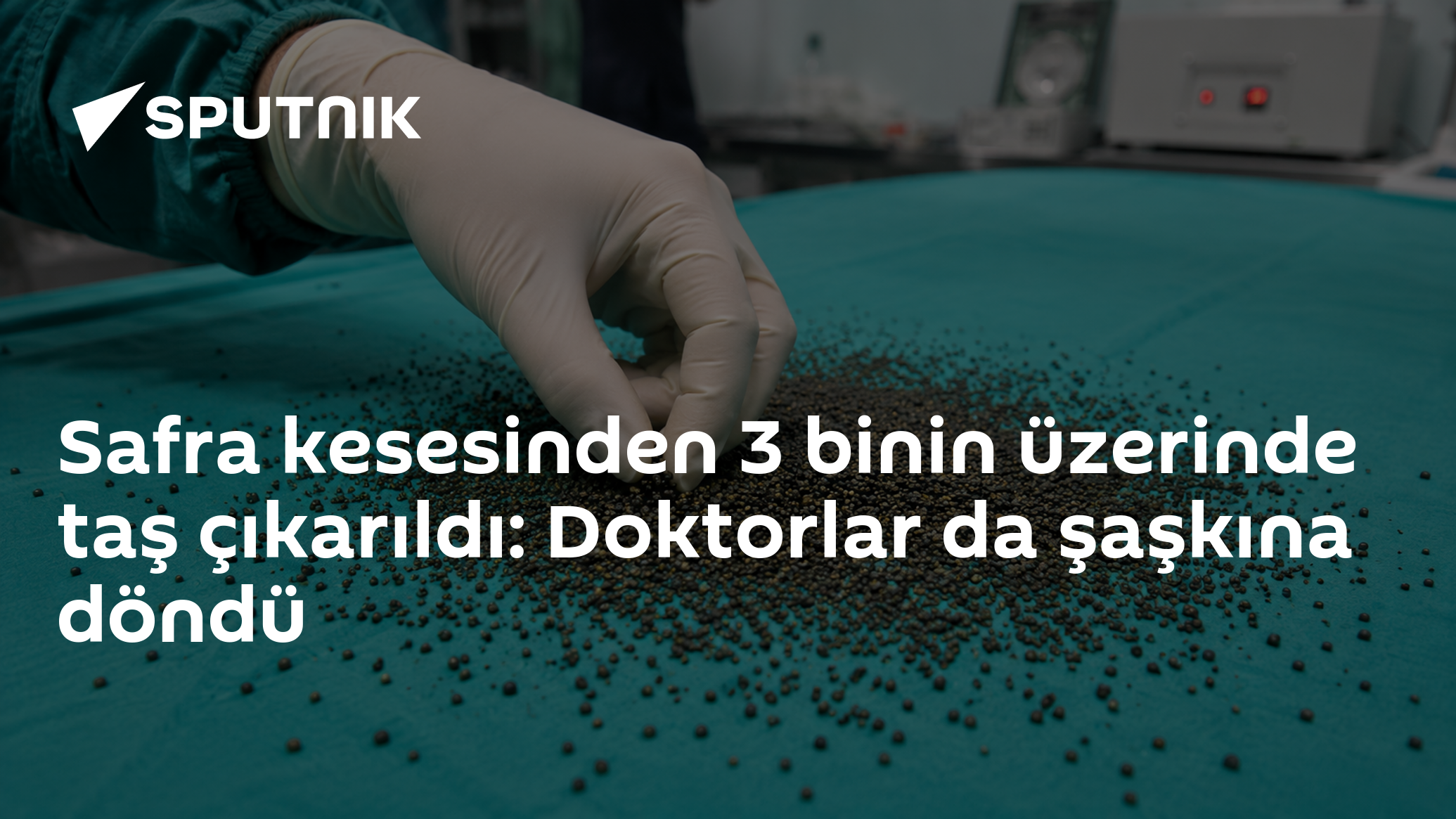 Safra kesesinden 3 binin üzerinde taş çıkarıldı: Doktorlar da şaşkına döndü