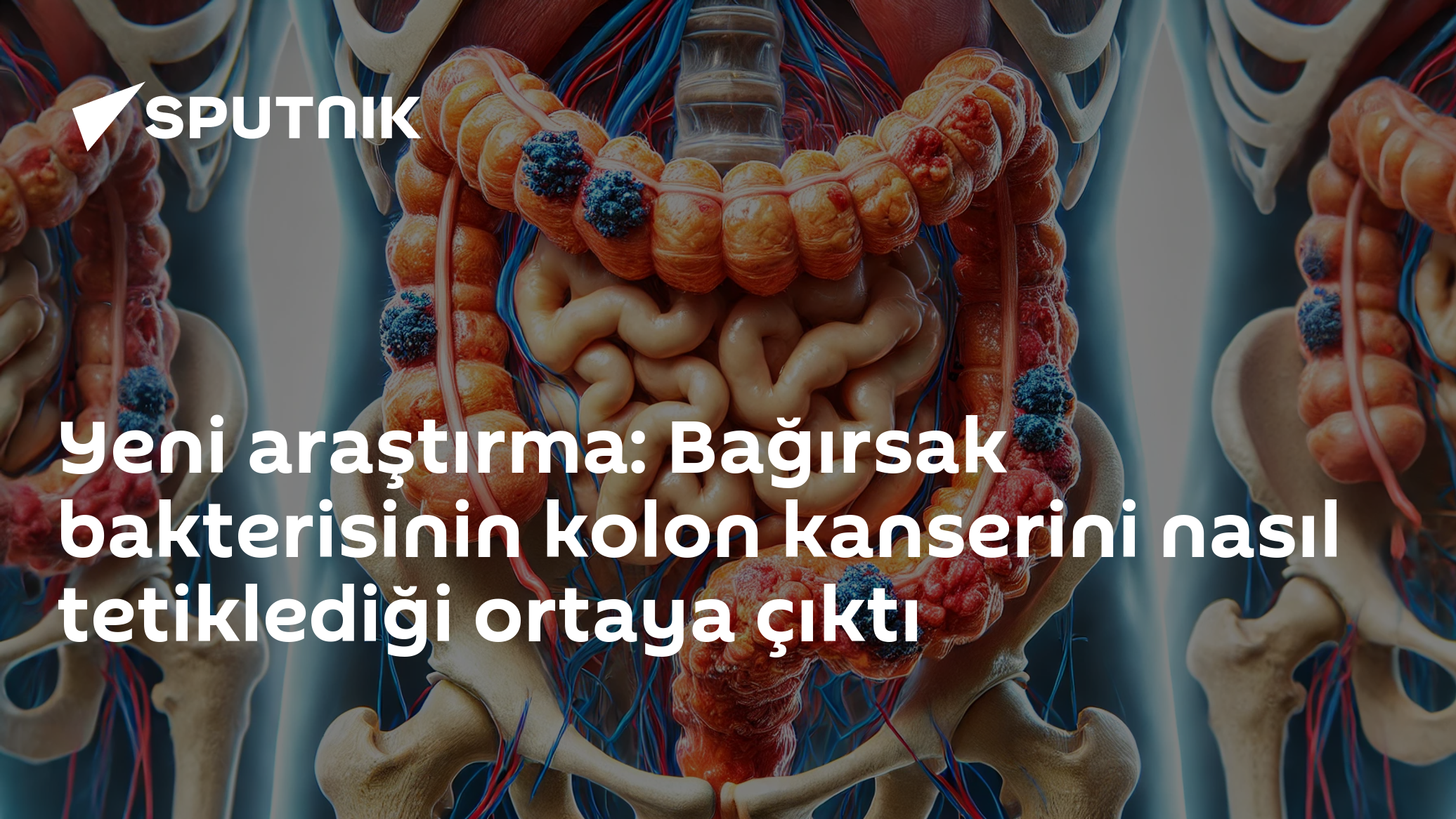 Yeni araştırma: Bağırsak bakterisinin kolon kanserini nasıl tetiklediği ortaya çıktı