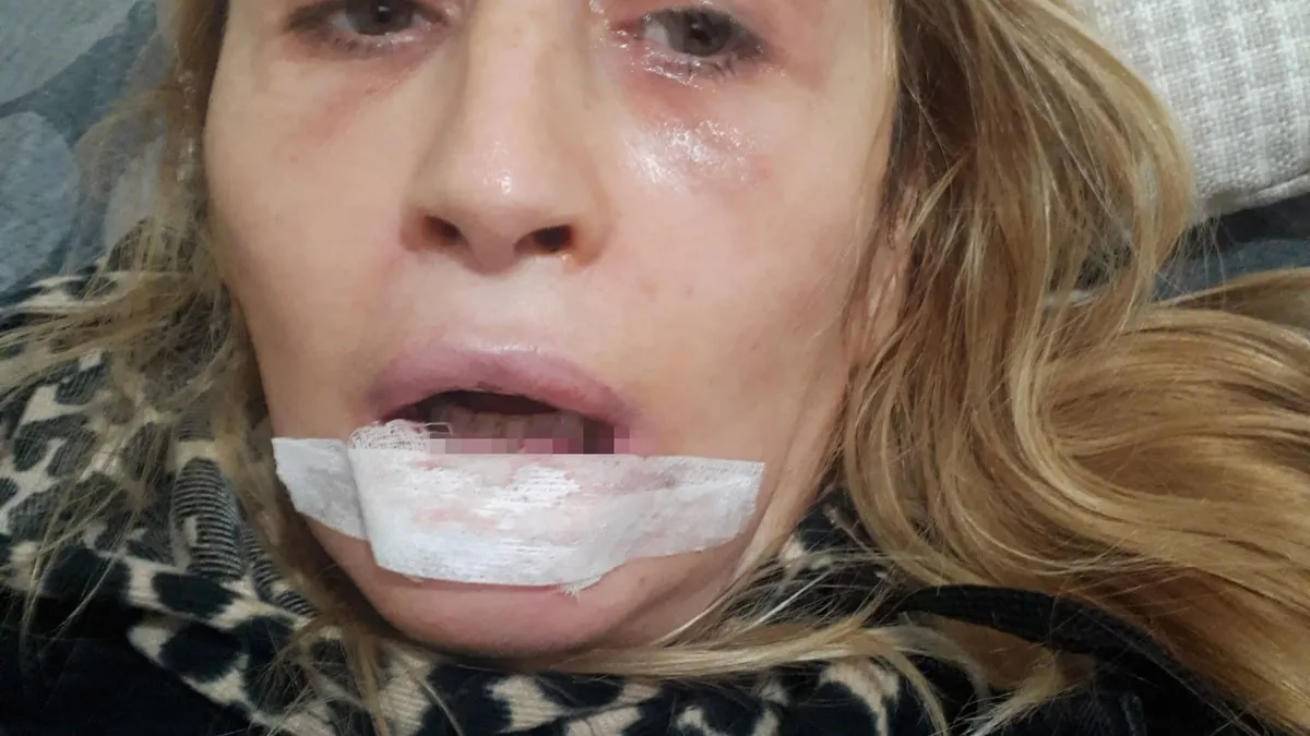 Estetik işlem sonrası dudağı çürüdü: 4 ameliyat geçirdi