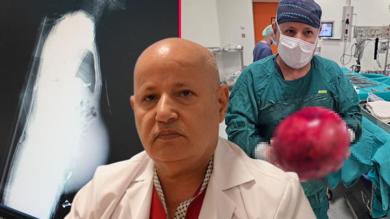 Doktora bir ilki yaşattı! Ameliyat korkusuyla 1,5 yıl bekledi, karnından çıkana inanamadılar