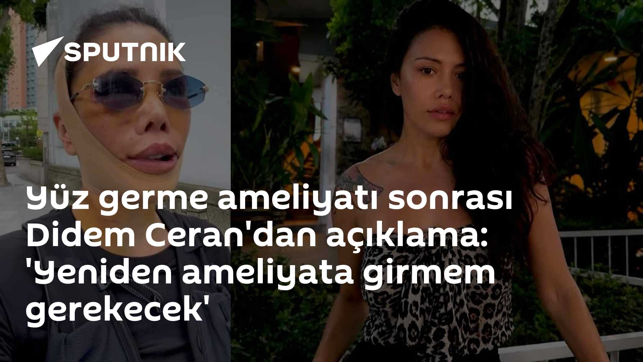 Yüz germe ameliyatı sonrası Didem Ceran'dan açıklama: 'Yeniden ameliyata girmem gerekecek'