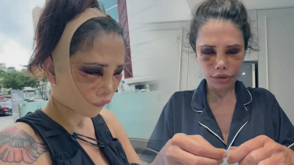 Didem Ceran kimdir? Eski Survivor yarışmacısı Didem Ceran ameliyat masasına yatmıştı: Yüzünün son halini filtresiz paylaştı