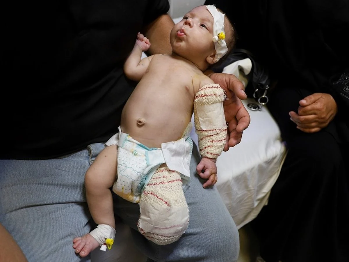 Gazze'de bacağı ampute edilen Muhammed bebek, şimdi de elini kaybedebilir