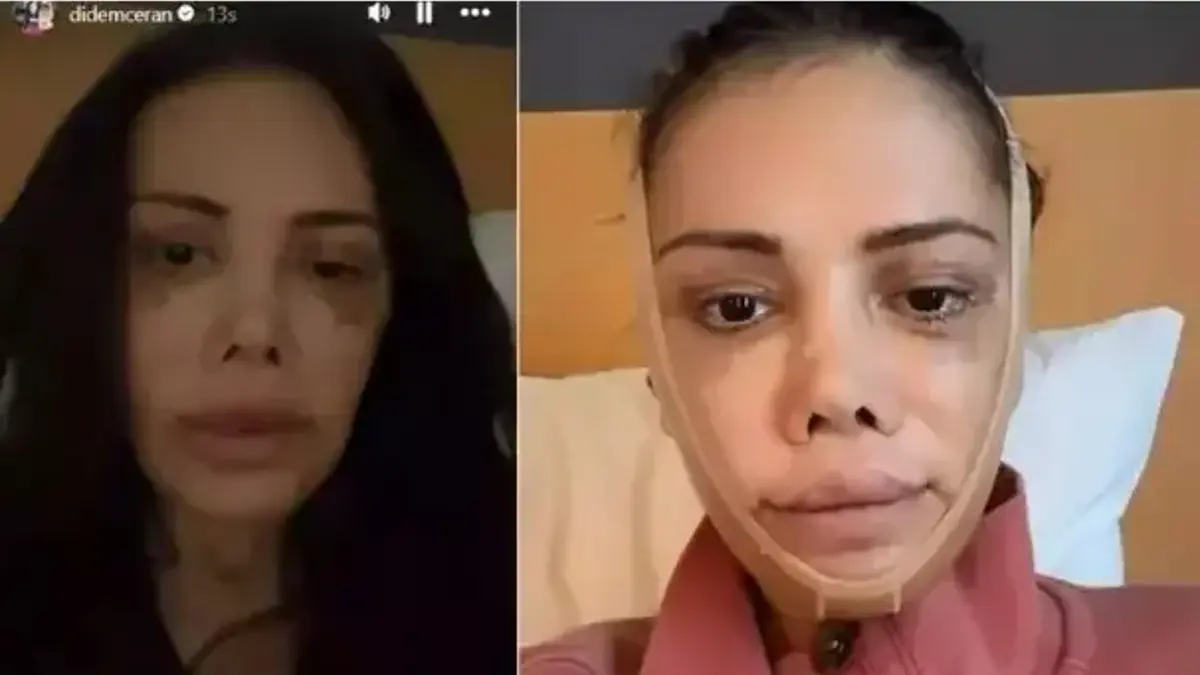 Yüz nakli sonrası değişimiyle gündemdeydi! Didem Ceran kendisini dünyaca ünlü yıldızla kıyasladı