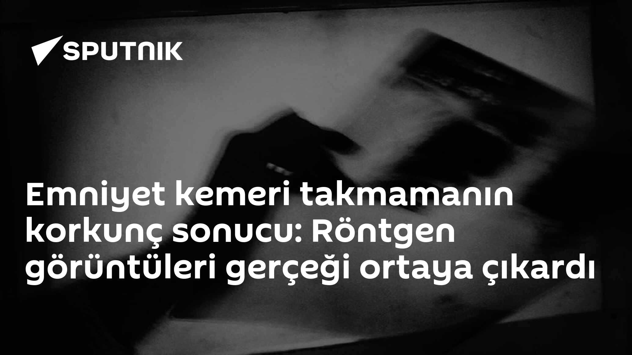 Emniyet kemeri takmamanın korkunç sonucu: Röntgen görüntüleri gerçeği ortaya çıkardı