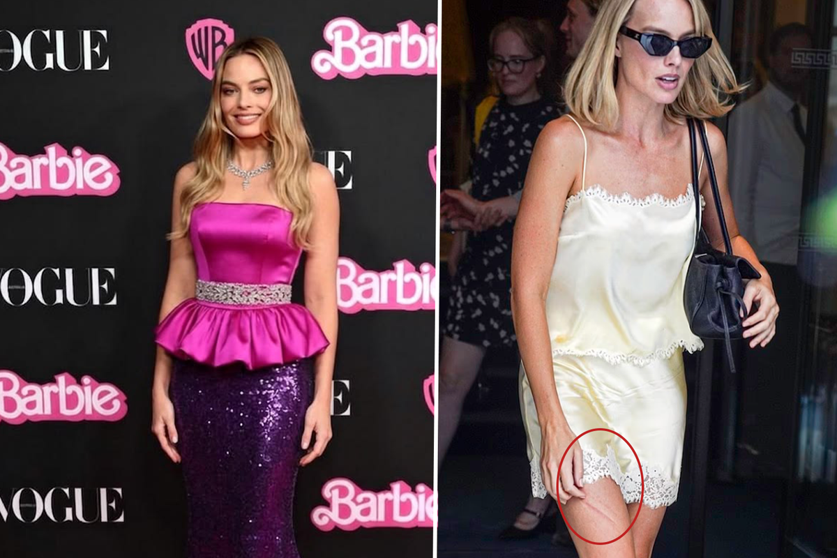 Barbie yıldızı Margot Robbie'nin bacağındaki morluk hayranlarını endişelendirdi