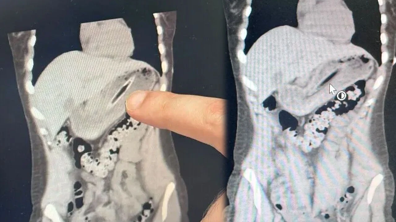 Bakın zayıflamak için ne yapmış! Canından oluyordu