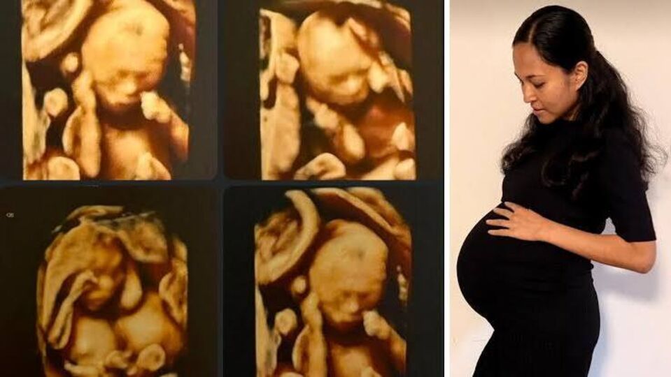 Doğal yolla gebelik sonucu tek yumurta dördüzleri dünyaya geldi