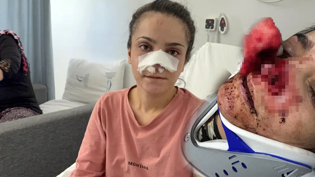 Eşi tarafından burnu koparılmıştı! Kabusu yaşayan kadın o anları anlattı