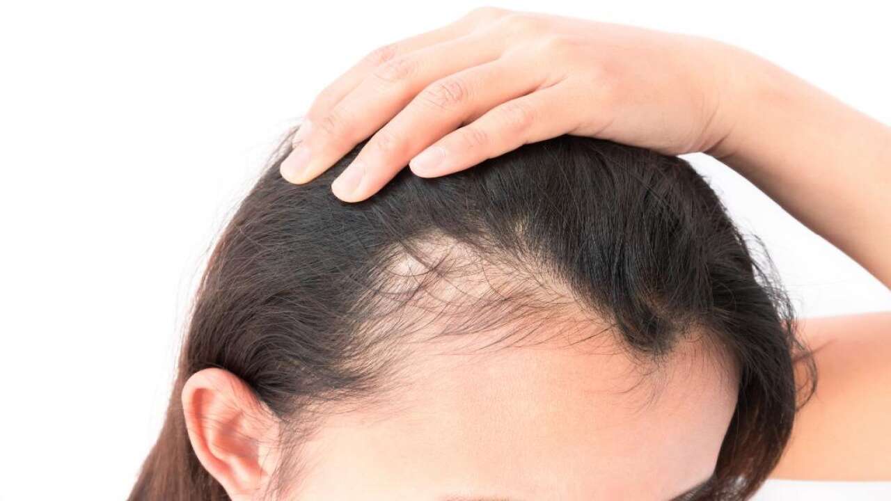 Kadınlarda saç dökülmesine dikkat: Altında hormonal ve sağlık sorunları yatabilir