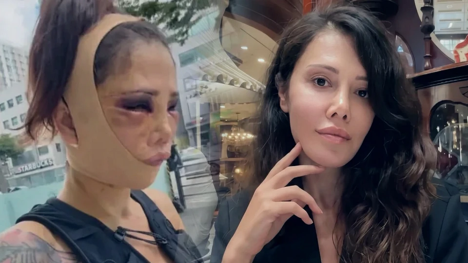 Survivor Didem Ceran'a ne oldu? Güney Kore'deki estetik operasyon sonrası bir ameliyat daha gündemde