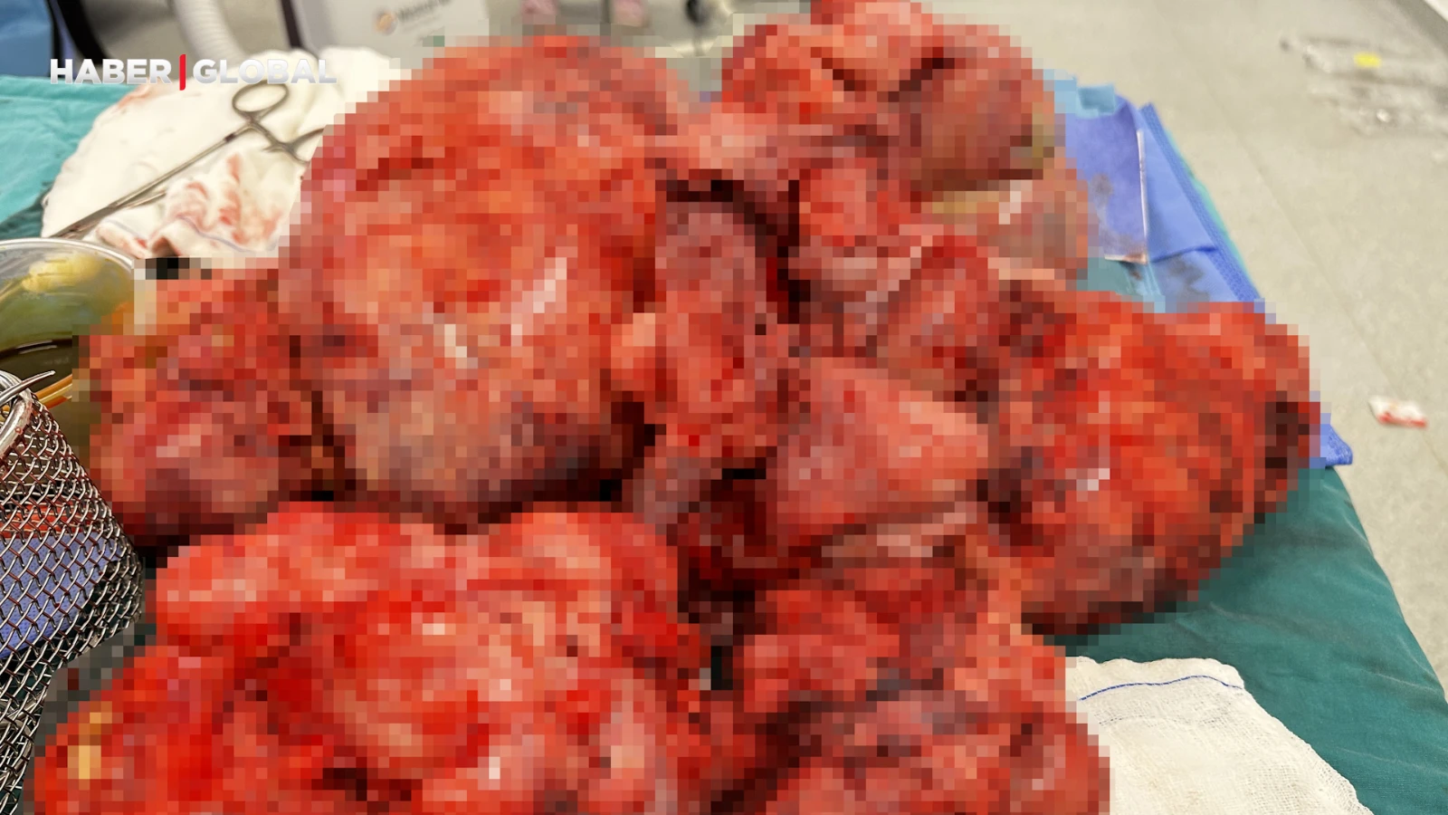 45 yaşındaki kadından çıkarıldı: Tam 60 santimetre çapında, 17 kilogram ağırlığında!