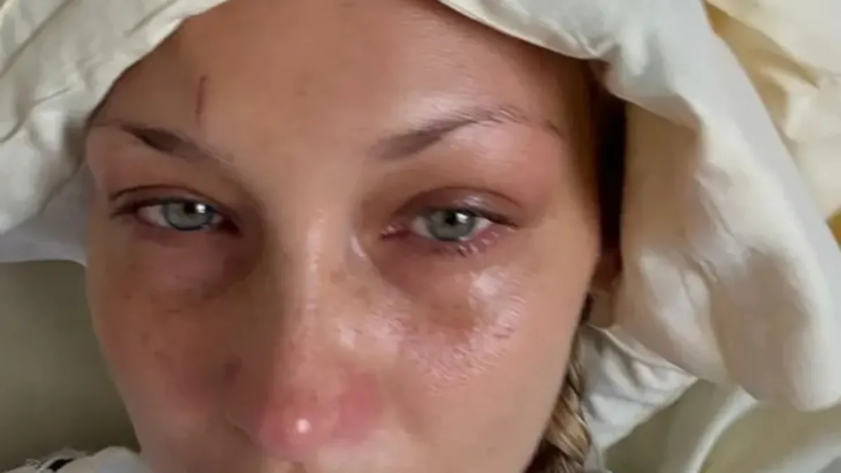 Lyme hastalığıyla mücadele eden Bella Hadid’den kötü haber!