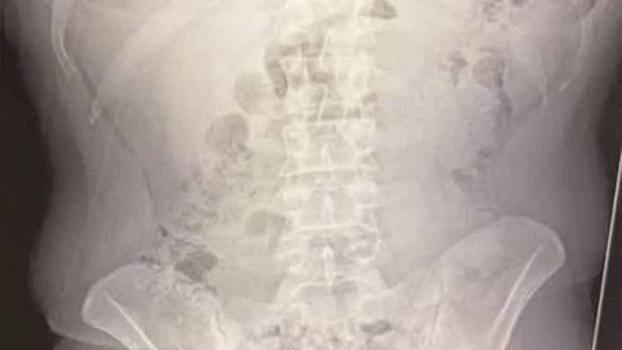 Röntgeni çeken doktorlar gözlerine inanamadı! Mide ve bağırsaklarından adeta ölüm saçıldı!