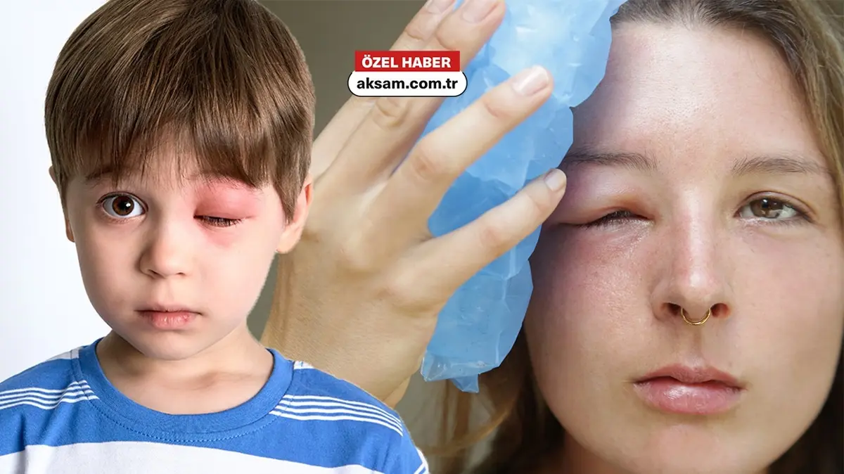 Dikkat! Arı alerjisi öldürebilir! İşte çocuklar ve yetişkinler arasındaki farklar