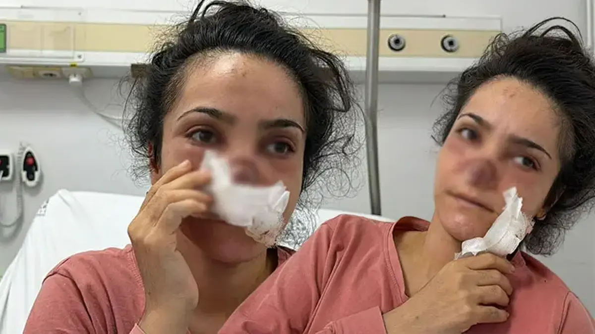 Eşi tarafından burnu ısırılıp koparılan kadın konuştu: Acıyla balkondan atlamayı bile düşündüm