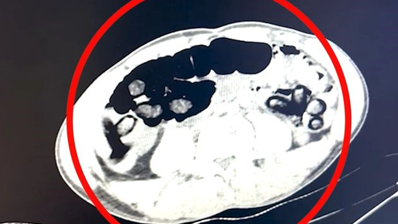 Midelerinden 2 kilo 700 gram uyuşturucu madde çıktı