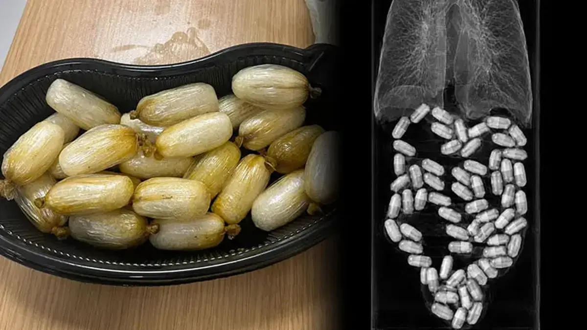 Midesinden 62 paket uyuşturucu çıktı! 590 gram metamfetaminle yakalandı