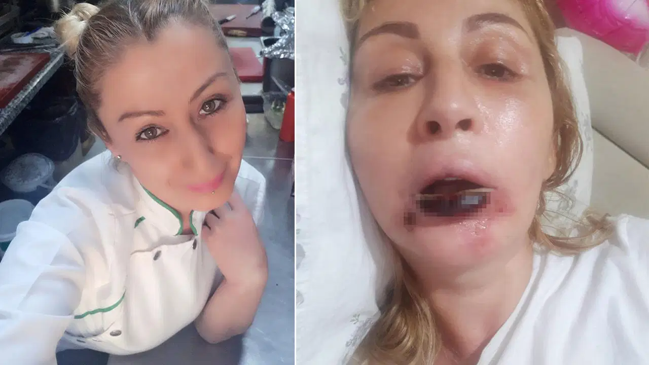 Estetik sonrası dudağı çürüdü: 7 yıldır hukuk mücadelesi veriyor