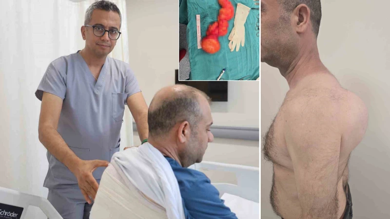 Doktorlar şaştı kaldı: Sırtındaki 10 yıllık kitlenin içinden 1 buçuk kilogramlık tümör çıktı