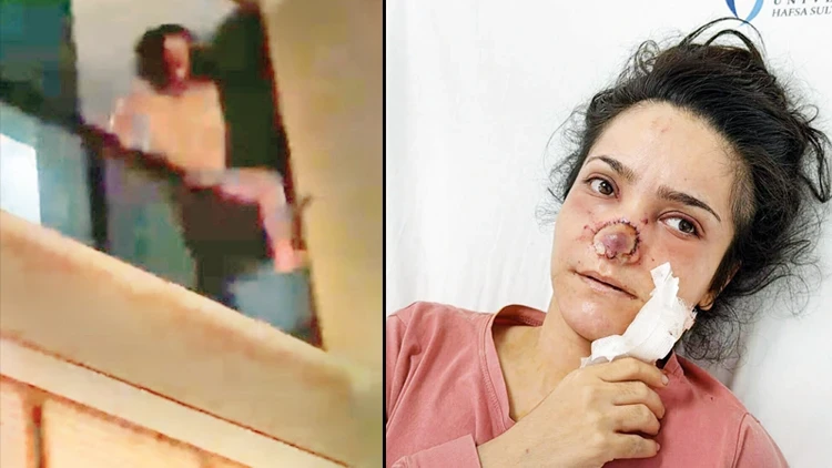 Burnu ısırılıp koparılan İmran: Acıdan atlamayı düşündüm