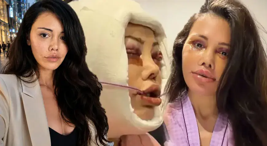 Didem Ceran 15 saatlik operasyona yüz nakli olmuştu! Kendisini dünyaca ünlü yıldızla karşılaştırdı
