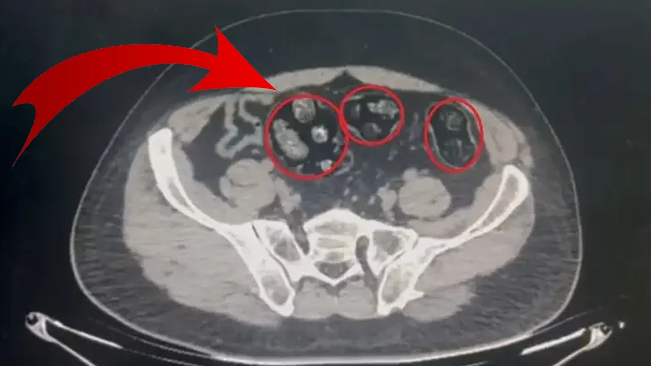 Mide ve Bağırsaklarından Çıkanlar Şok Etti! 62 Parça Halinde Tam 502 Gram...
