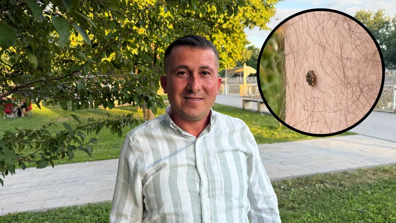 Bacağında keneyle nişana gitti