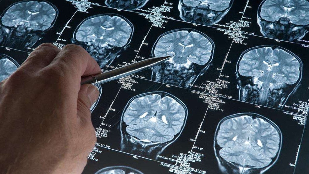 Alzheimer'da yeni umut: Kan testi hem tanı koyuyor hem riski öngörüyor
